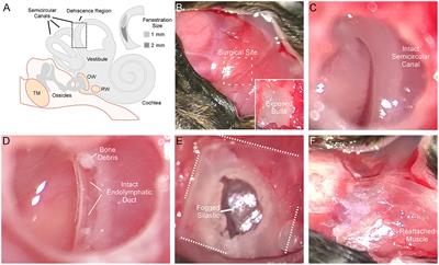 New model of superior semicircular canal dehiscence with reversible diagnostic findings characteristic of patients with the disorder